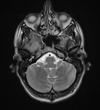 File:Cerebral abscess (Radiopaedia 60342-68009 Axial T2 6).png