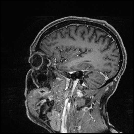 Cerebral abscess with ventriculitis (Radiopaedia 78965-91878 Sagittal T1 C+ 132).jpg