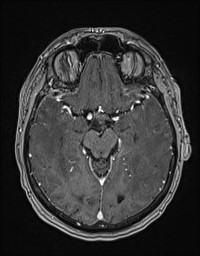 Cerebral amyloid angiopathy-related inflammation (Radiopaedia 58270-65377 Axial T1 C+ fat sat 57).jpg