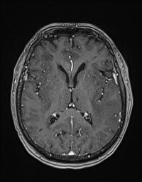 Cerebral amyloid angiopathy-related inflammation (Radiopaedia 58270-65377 Axial T1 C+ fat sat 75).jpg