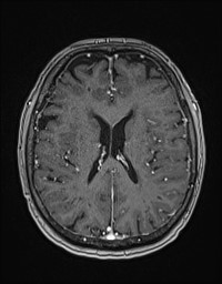 Cerebral amyloid angiopathy-related inflammation (Radiopaedia 58270-65377 Axial T1 C+ fat sat 89).jpg