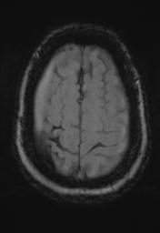 File:Cerebral amyloid angiopathy (Radiopaedia 29129-29518 Axial SWI Magnitude 31).jpg