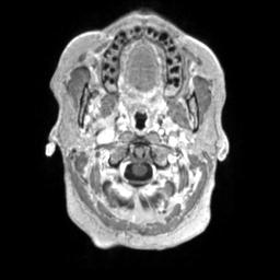 Cerebral amyloid angiopathy (Radiopaedia 29129-29518 Axial T1 C+ 11).jpg