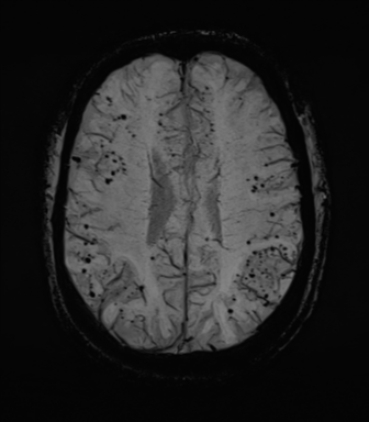 File:Cerebral amyloid angiopathy (Radiopaedia 46082-50433 Axial SWI MIP 53).png