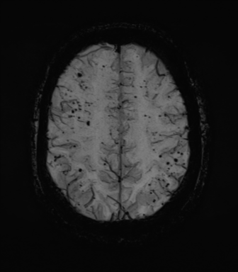 Cerebral amyloid angiopathy (Radiopaedia 46082-50433 Axial SWI MIP 59).png