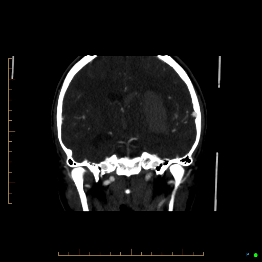 Cerebral arteriovenous malformation (AVM) (Radiopaedia 78162-90706 Coronal CTA 53).jpg