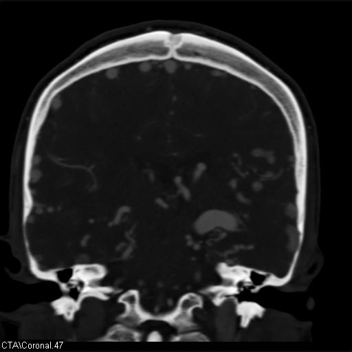 Cerebral arteriovenous malformation (Radiopaedia 28518-28759 C 47).jpg