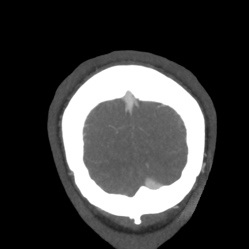 Cerebral arteriovenous malformation (Radiopaedia 39259-41505 E 66).png