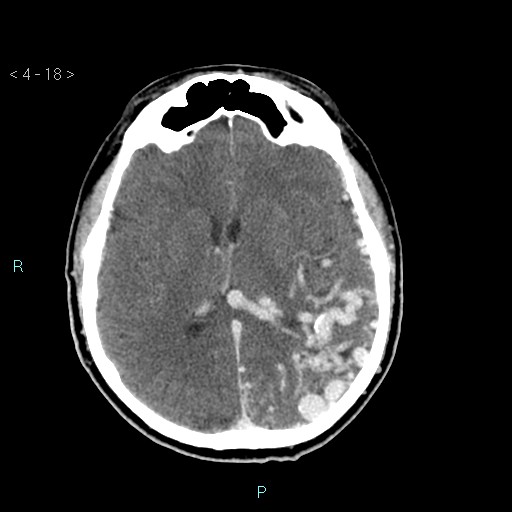 File:Cerebral arteriovenous malformation (Radiopaedia 40528-43125 Axial C+ delayed 18).jpg