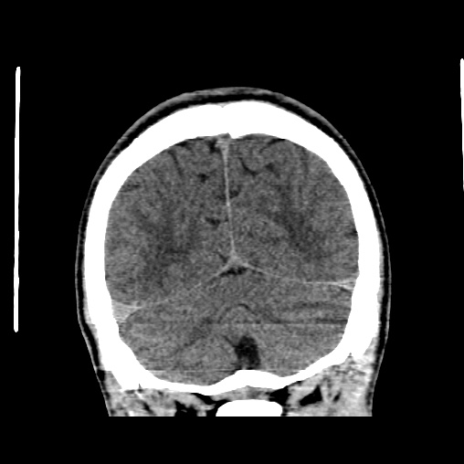 Cerebral arteriovenous malformation (Radiopaedia 61964-70028 Coronal non-contrast 50).jpg