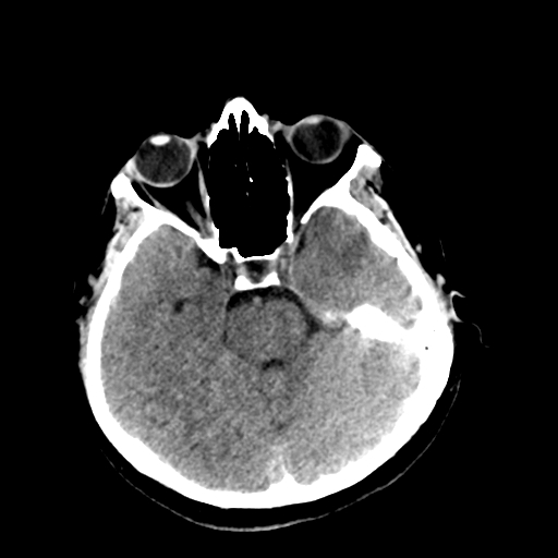 File:Cerebral arteriovenous malformation (Radiopaedia 73830-84645 Axial non-contrast 15).jpg