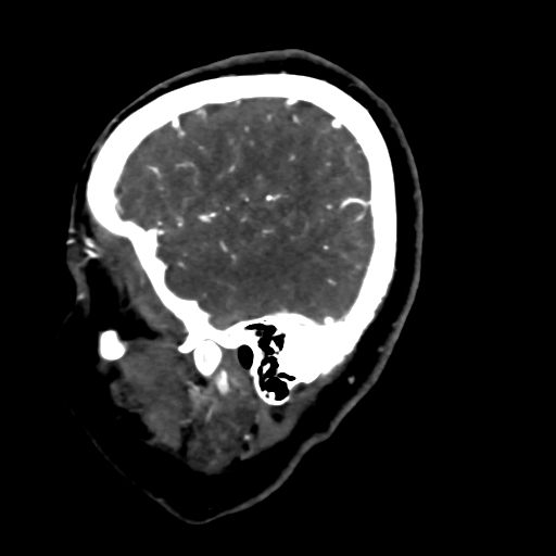 Cerebral arteriovenous malformation (Radiopaedia 73830-84645 Sagittal C+ delayed 14).jpg
