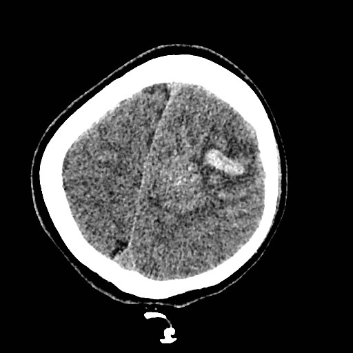 File:Cerebral arteriovenous malformation (Radiopaedia 79677-92887 Axial non-contrast 42).jpg