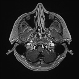 File:Cerebral arteriovenous malformation (Radiopaedia 84015-99245 Axial T1 C+ 29).jpg