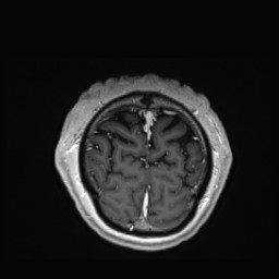 Cerebral arteriovenous malformation (Radiopaedia 84015-99245 Coronal T1 C+ 156).jpg