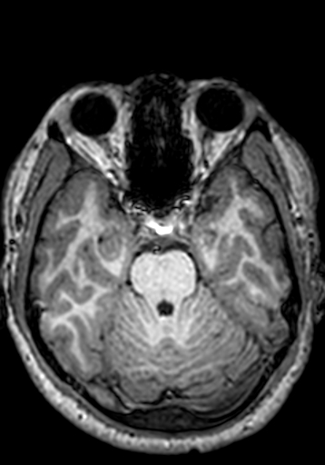 Cerebral arteriovenous malformation at posterior body of corpus callosum (Radiopaedia 74111-84925 Axial T1 211).jpg
