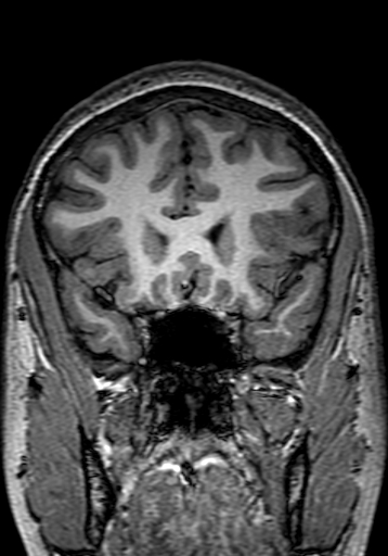 Cerebral arteriovenous malformation at posterior body of corpus callosum (Radiopaedia 74111-84925 Coronal T1 94).jpg