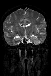 Cerebral arteriovenous malformation at posterior body of corpus callosum (Radiopaedia 74111-84925 Coronal T2 87).jpg