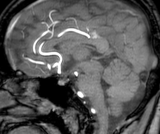 Cerebral arteriovenous malformation at posterior body of corpus callosum (Radiopaedia 74111-84925 J 199).jpg