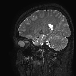 Cerebral arteriovenous malformation at posterior body of corpus callosum (Radiopaedia 74111-84925 Sagittal T2 42).jpg