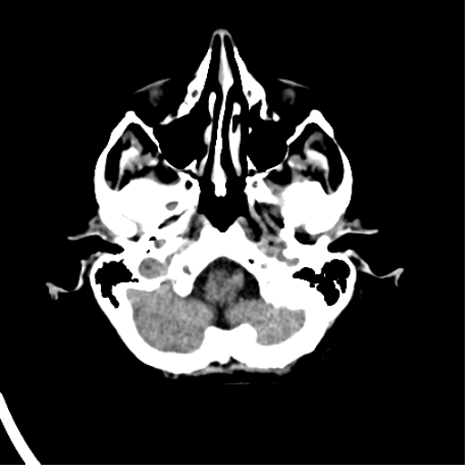 File:Cerebral arteriovenous malformation with lobar hemorrhage (Radiopaedia 44725-48510 Axial non-contrast 10).png