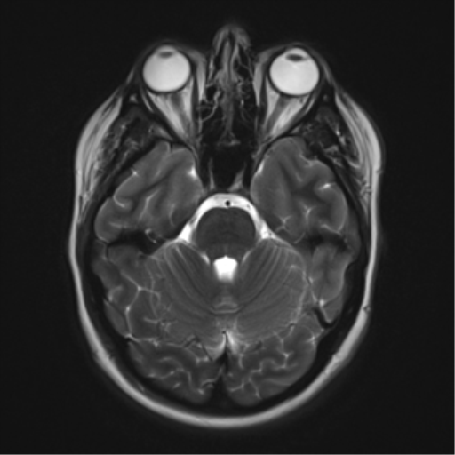 File:Cerebral cavernoma and development venous anomaly (Radiopaedia 37603-39482 Axial T2 7).png