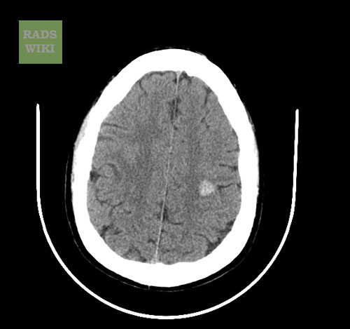 File:Cerebral cavernous malformation (Radiopaedia 11284-32087 Axial non-contrast 1).jpg