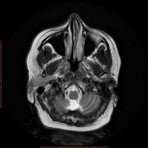 File:Cerebral cavernous malformation (Radiopaedia 26177-26306 Axial T2 4).jpg