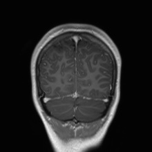 File:Cerebral cavernous venous malformation (Radiopaedia 70008-80021 Coronal T1 C+ 12).jpg
