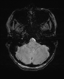 Cerebral cavernous venous malformation (Radiopaedia 70008-80021 I 12).jpg