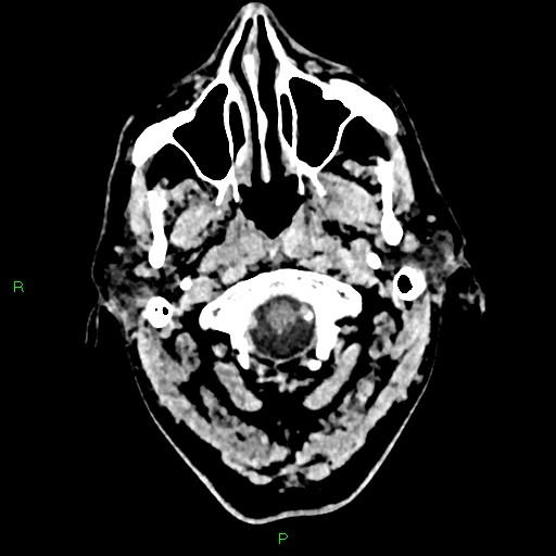 Cerebral contusions (Radiopaedia 33868-35039 Axial non-contrast 6).jpg