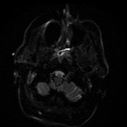 Cerebral embolic infarcts (embolic shower) (Radiopaedia 49837-55108 Axial DWI 45).jpg