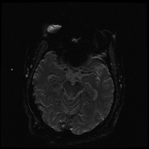 Cerebral embolic infarcts (embolic shower) (Radiopaedia 49837-55108 Axial SWI 46).jpg
