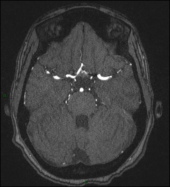 Cerebral fat embolism (Radiopaedia 35022-36525 Axial TOF 66).jpg