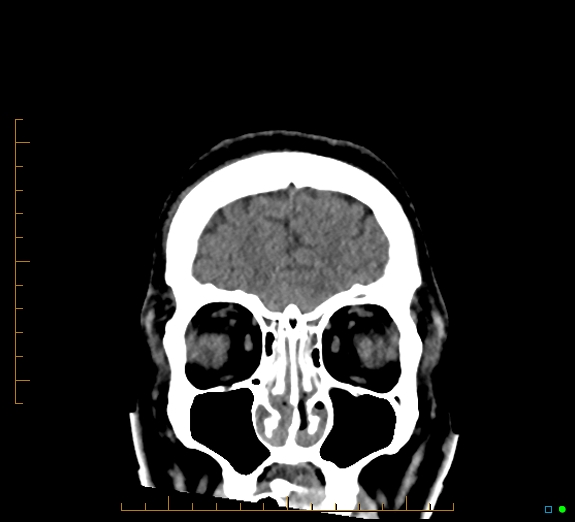 Cerebral fat embolism (Radiopaedia 85521-101224 Coronal non-contrast 12).jpg