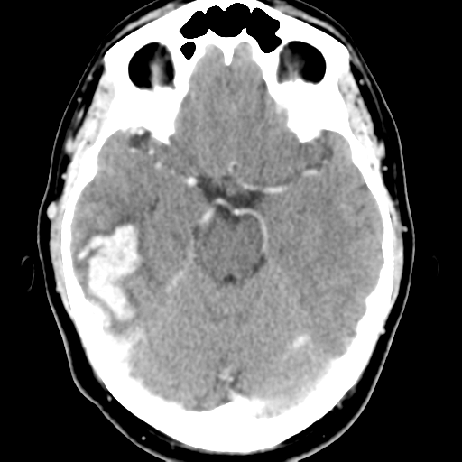 File:Cerebral hemorrhage secondary to arteriovenous malformation (Radiopaedia 33497-34561 B 20).png