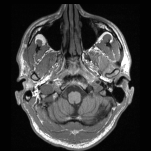 File:Cerebral hemorrhagic contusions- temporal evolution (Radiopaedia 40224-42757 Axial T1 11).png