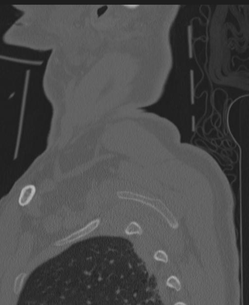 Cerebral hemorrhagic contusions and cervical spine fractures (Radiopaedia 32865-33841 Sagittal bone window 98).jpg