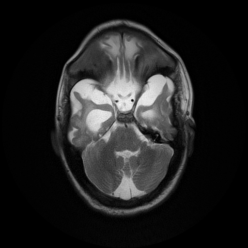 File:Cerebral manifestations of mucopolysaccharidosis type I (Radiopaedia 59171-66487 Axial T2 6).jpg