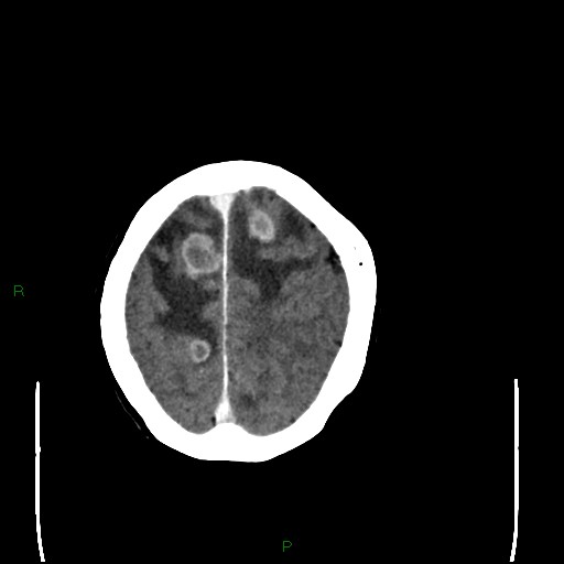 Cerebral metastases - breast primary (Radiopaedia 77653-89857 Axial C+ delayed 97).jpg