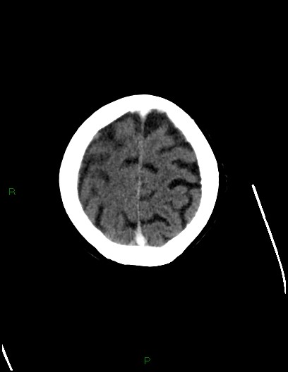 Cerebral metastases - ependymal and parenchymal (Radiopaedia 79877-93131 Axial C+ delayed 72).jpg
