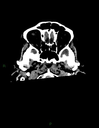 Cerebral metastases - ependymal and parenchymal (Radiopaedia 79877-93131 Axial non-contrast 2).jpg