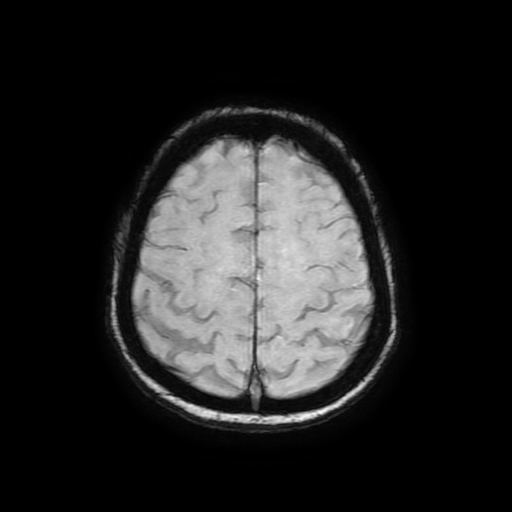 Cerebral metastases - melanoma (Radiopaedia 80972-94522 Axial SWI 78).jpg