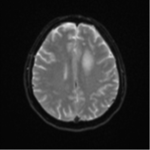 Cerebral metastases mimicking abscesses (Radiopaedia 45841-50131 Axial DWI 20).png