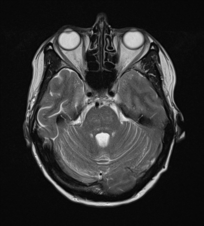 File:Cerebral metastasis (Radiopaedia 46744-51248 Axial T2 8).png