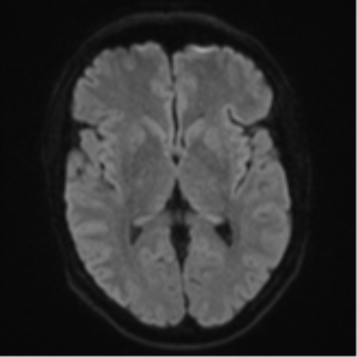 Cerebral metastasis - colorectal adenocarcinoma (Radiopaedia 50394-55765 Axial DWI 41).png