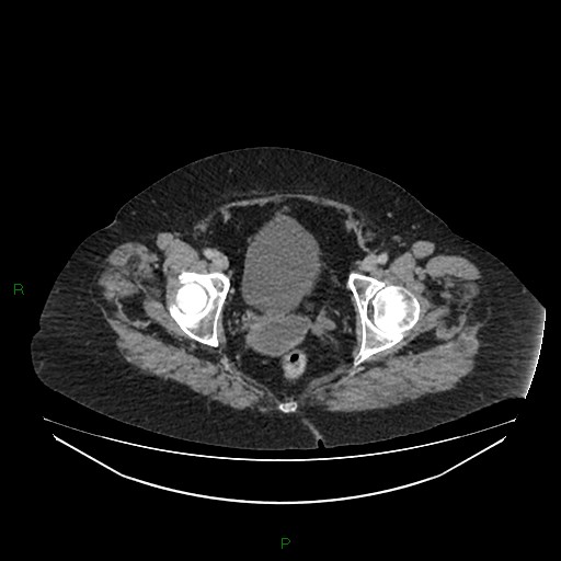 File:Cerebral metastasis from renal cell carcinoma (Radiopaedia 82306-96378 A 179).jpg