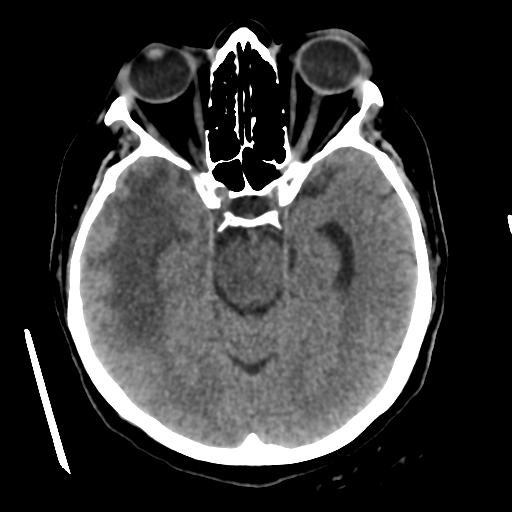Cerebral metastasis to basal ganglia (Radiopaedia 81568-95412 Axial non-contrast 26).png
