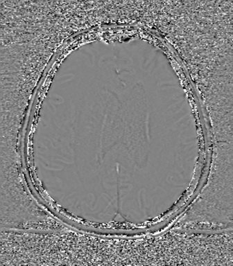 Cerebral metastasis to basal ganglia (Radiopaedia 81568-95413 Axial SWI phase 56).png