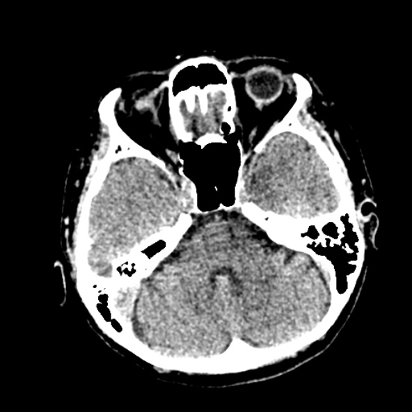 Cerebral ring enhancing lesions - cerebral metastases (Radiopaedia 44922-48818 Axial non-contrast 31).jpg